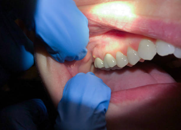 Best Emergency Dentist for Lost Fillings or Crowns in Abilene, TX
